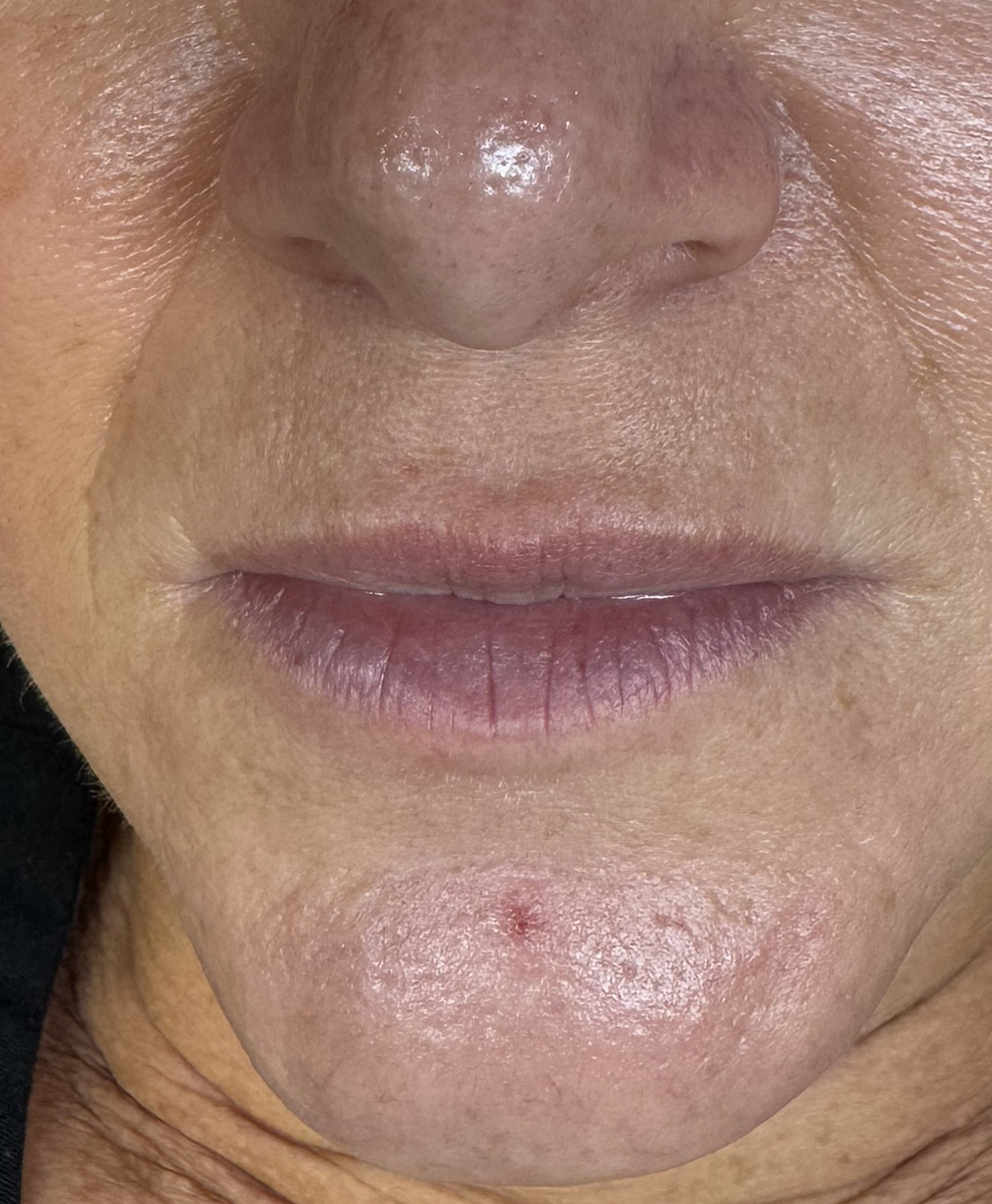 Before Image: Lip Blushing - front